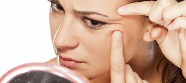 Acne: tutte le risposte alle tue domande