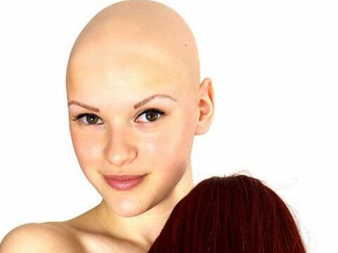 La ragazza che combatte l'alopecia con la musica