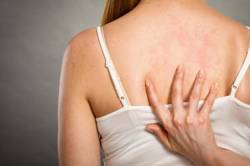 Orticaria: cause, cure e rimedi naturali per le forme acuta e cronica