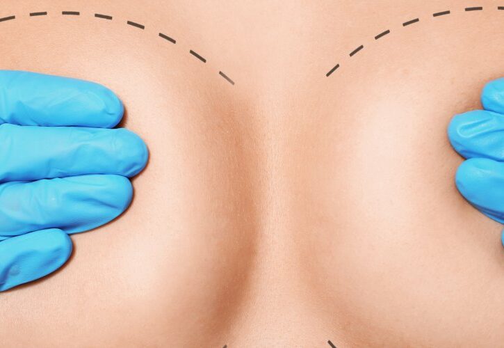 Seno rifatto: sì o no? Ecco tutto quello che devi sapere sulla mastoplastica additiva, prima e dopo