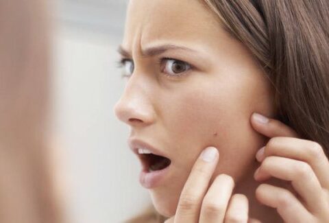 Tutte le cause dell'acne