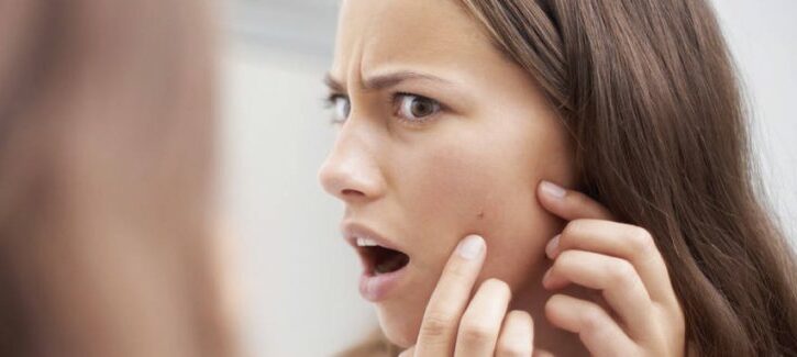 Tutte le cause dell'acne