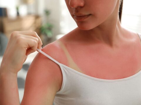 Come prendersi cura della pelle scottata dopo le vacanze