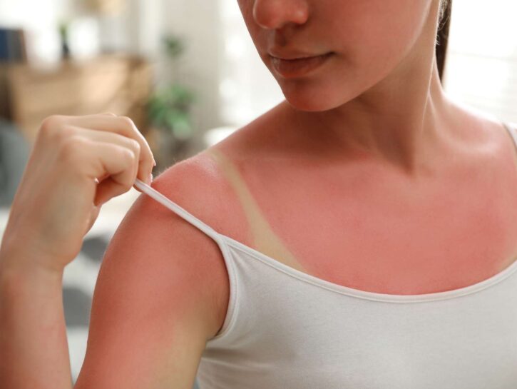 Come prendersi cura della pelle scottata dopo le vacanze