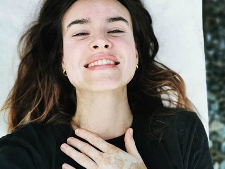 Vitiligine: storie di donne che non si nascondono