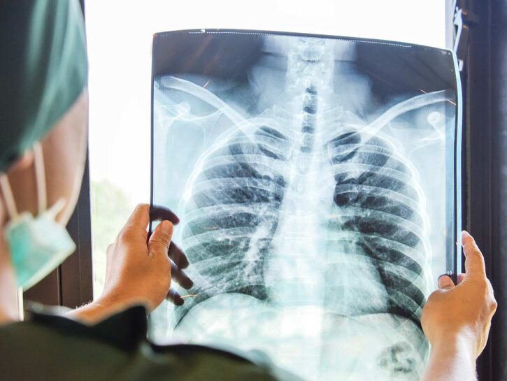 Cancro ai polmoni, scienziati lavorano al primo vaccino al mondo