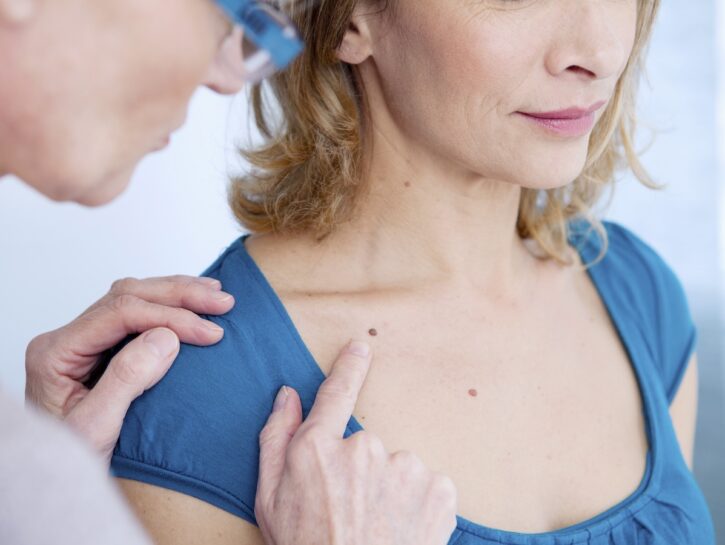 Neo sospetto? L'autoesame precoce ha cambiato le sorti del melanoma