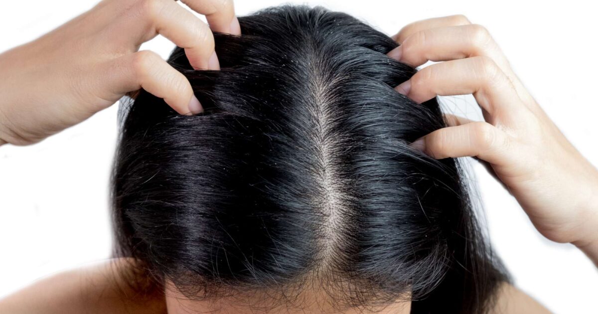 Dermatite seborréica, o que é e como tratar esta doença