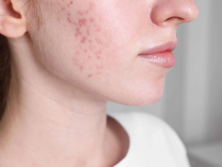 Acne estiva, cause e rimedi