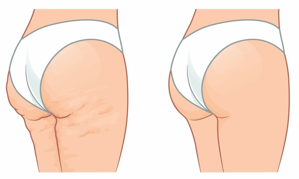 cellulite