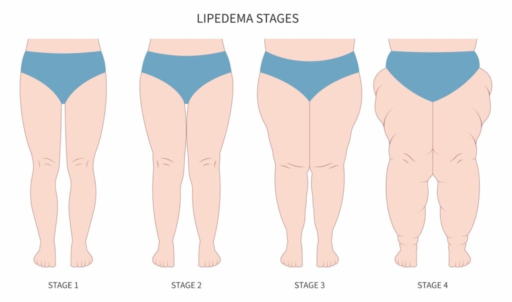 Lipedema