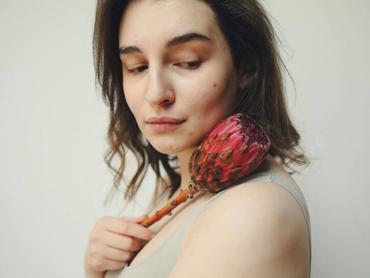 Acne, in aumento tra le donne adulte