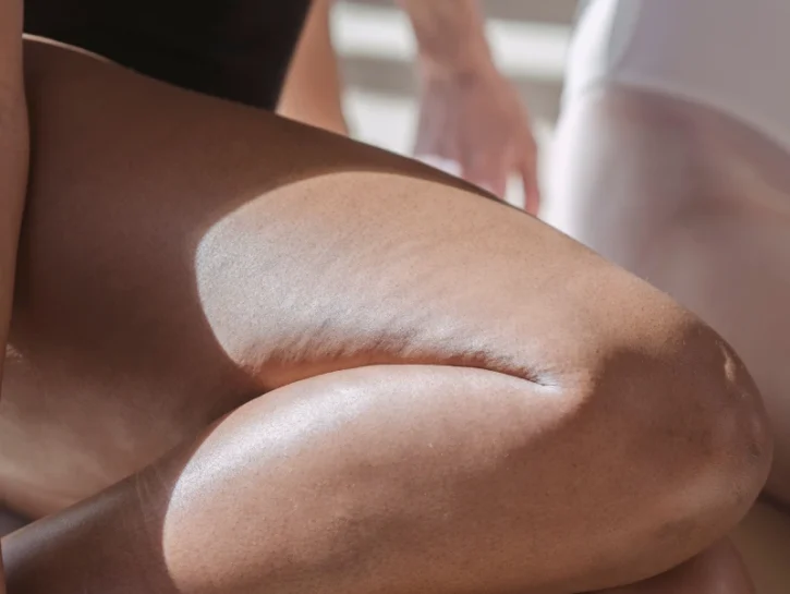 Lipedema: sintomi, cause e cura della malattia (che non è cellulite!)