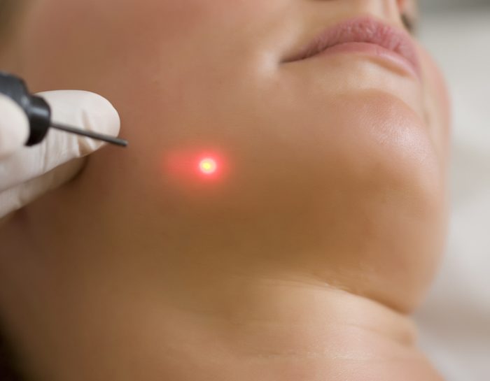 macchie viso laser