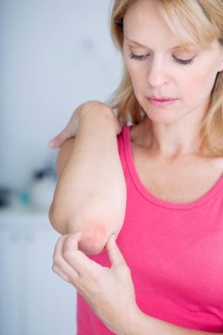 <p>Chi soffre di psoriasi spesso non sa che si tratta di una malattia infiammatoria sistemica (cioè che colpisce più apparati ed organi) e che è importante che venga gestita come tale. «Nelle persone affette da <b>psoriasi</b> vi è una maggiore incidenza di ipertensione, malattie coronariche, diabete e aumento di lipidi nel sangue - conferma la dottoressa Patrizia Paganini, specialista in dermatologia e venreologia - non si tratta certo di una patologia grave, però comporta effetti che incidono in maniera importante sulla <b>qualità di vita </b>e delle relazioni sociali. Le manifestazioni cutanee possono essere così importanti da indurre il paziente ad un vero e proprio <b>autoisolamento</b>».</p>