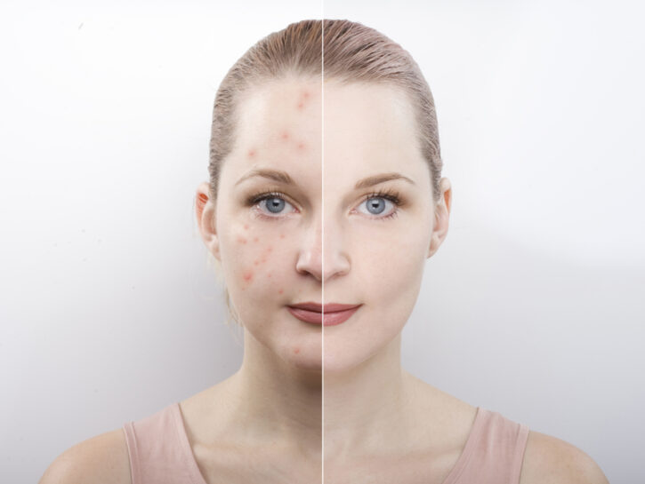 rimedi contro cicatrici acne