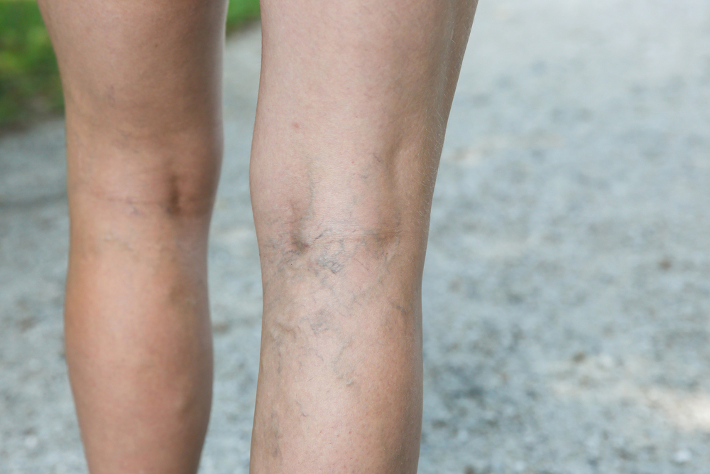 problema di vene alle gambe