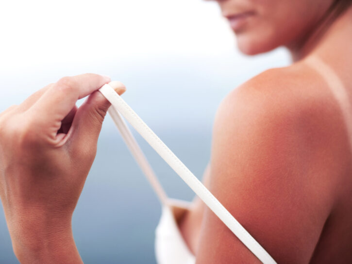 cheratosi attinica cure naturali